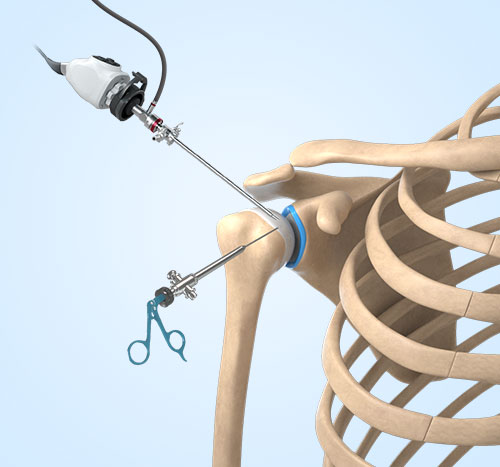 Picture of Arthroscopic Surgery