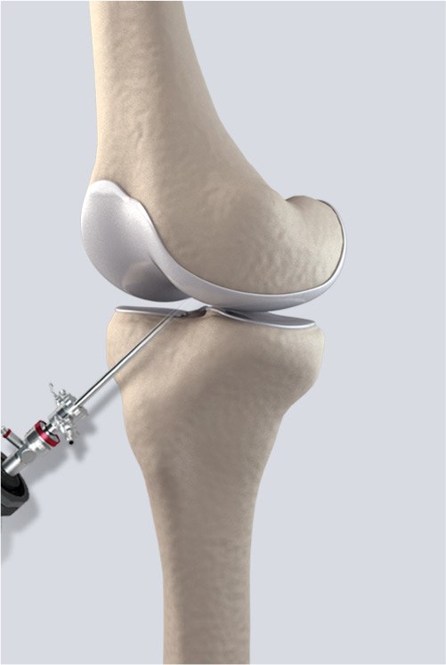 Picture of Arthroscopic Surgery