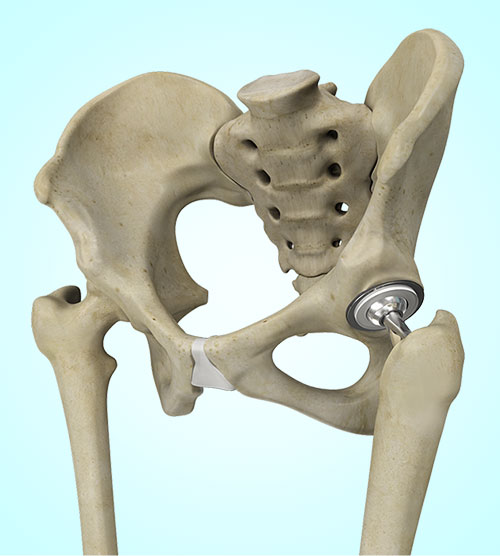 Picture of Hip & Knee Replacement