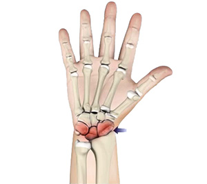 Arthritis of the Wrist images