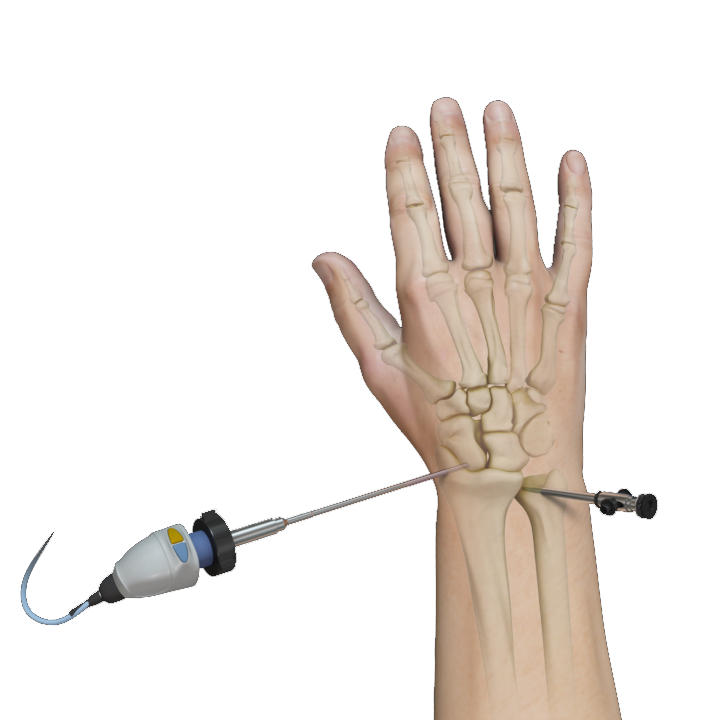 Arthroscopic Wrist Surgery images