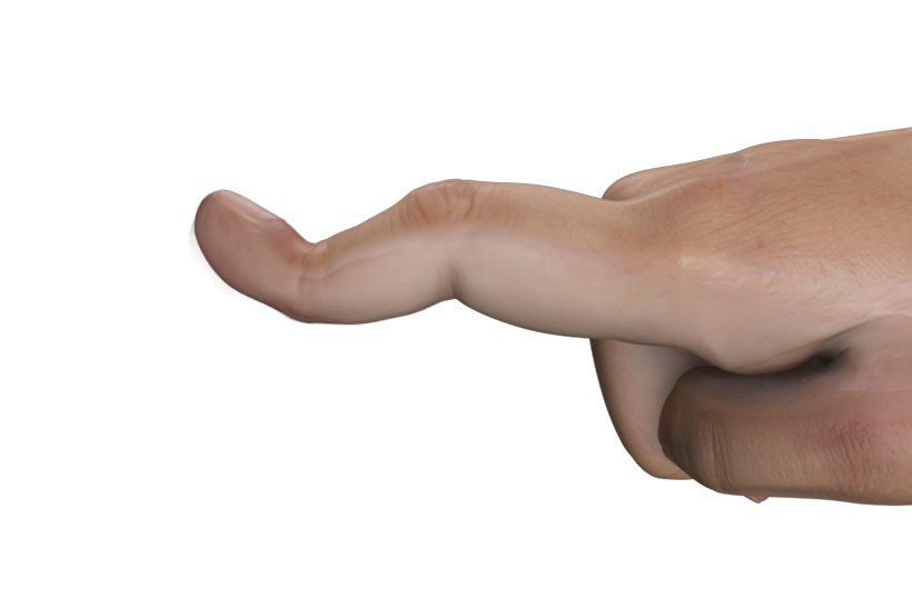 Boutonniere Deformity images