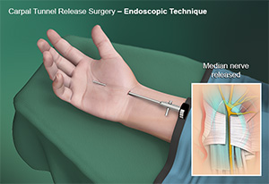 Endoscopic Carpal Tunnel Release images