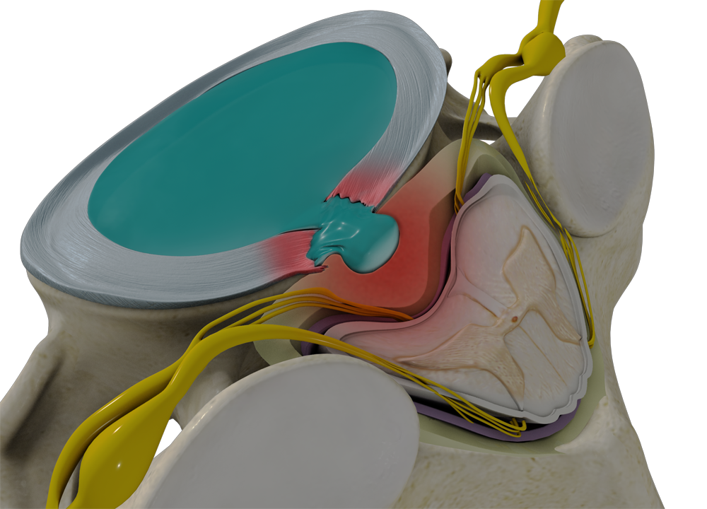 Cervical Disc Herniation images