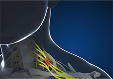 Complex Nerve Injury Icon