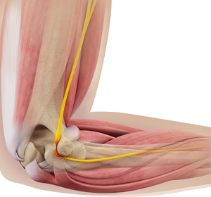 Cubital Tunnel Syndrome (Ulnar Nerve Entrapment) images