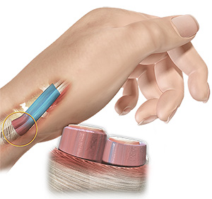 De Quervain's Tendinosis images