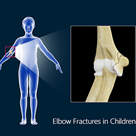 Elbow Fractures in Children Icon