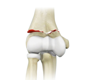 Elbow Fractures images