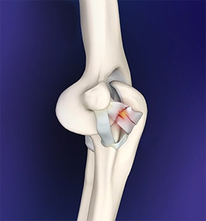 Elbow Ligament Reconstruction images