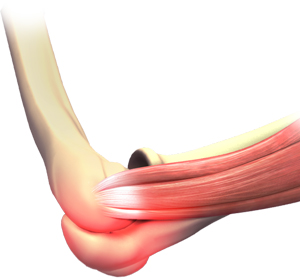 Elbow Sprain images