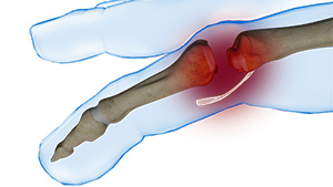 Finger Dislocation images