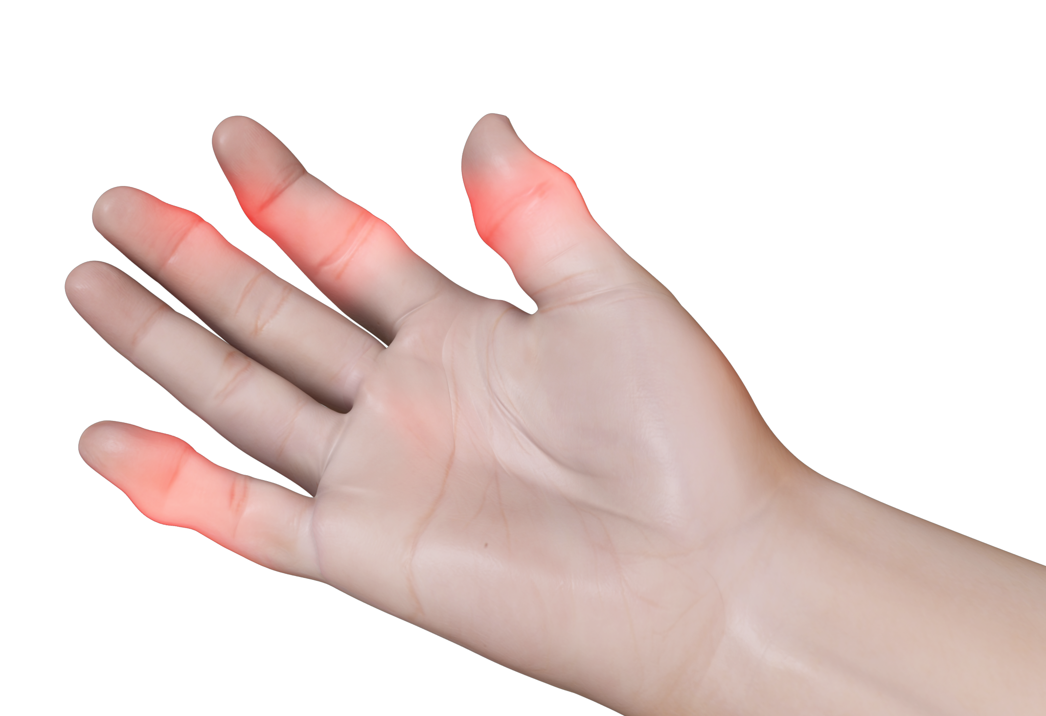 Finger Sprain images