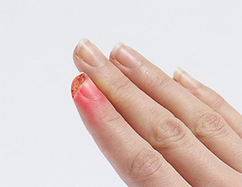 Fingertip Injuries images