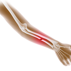 Forearm Fractures in Children Icon