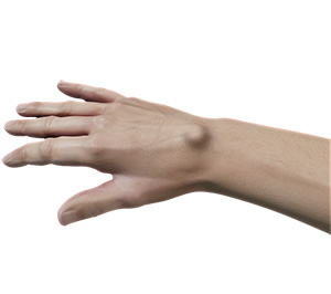 Ganglion Cyst images