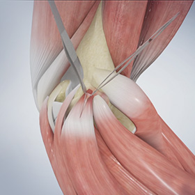 Golfer's Elbow images