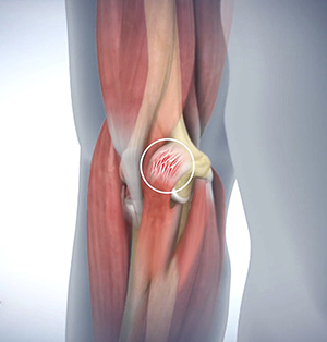 Golfer's Elbow Surgery images