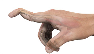 Mallet Finger images