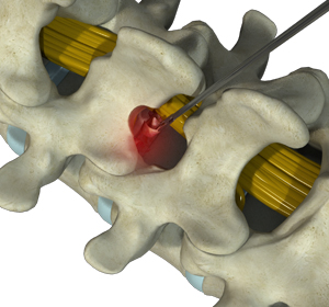 Microdiscectomy images