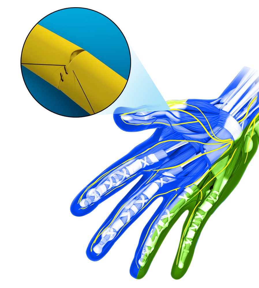 Vertebroplasty images