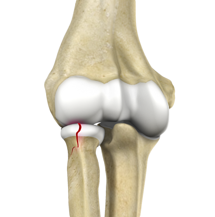 Radial Head Fractures of the Elbow images