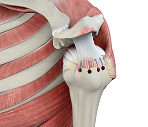 Rotator Cuff Repair images