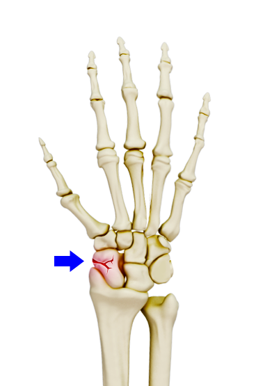Scaphoid Fracture images