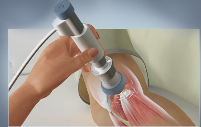 Shockwave therapy for Tennis Elbow images