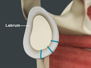 Shoulder Labrum Reconstruction images