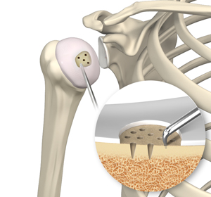 Shoulder Preservation Surgery images