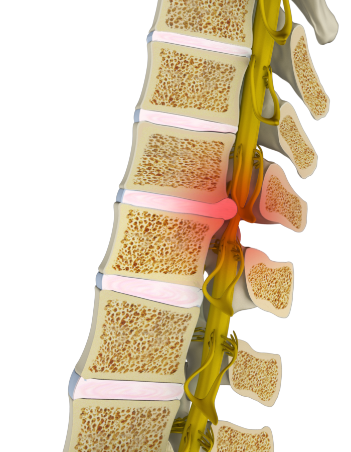 Spinal Cord Compression images
