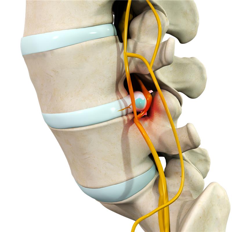 Spinal Disorders images