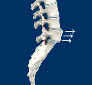 Spinal Instability images