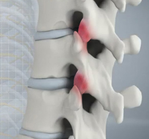 Spine Arthritis images