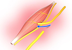 Targeted Muscle Reinnervation surgery Icon