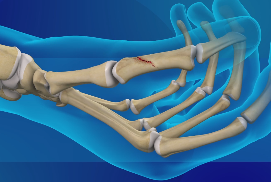 Thumb Fracture images