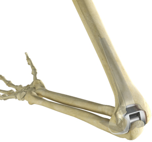 Total Elbow Replacement images