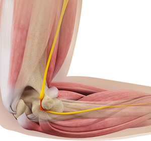 Ulnar Nerve Neuropathy images