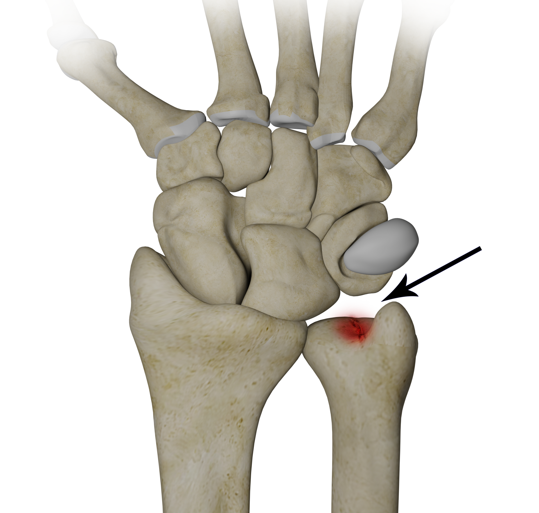 Ulnar Wrist Pain images