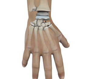 Wrist Joint Replacement images