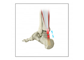 Achilles Tendon Repair