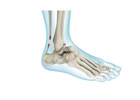 Achilles Tendon Rupture
