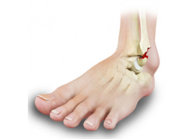 Ankle Fractures