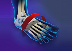 Ankle Instability