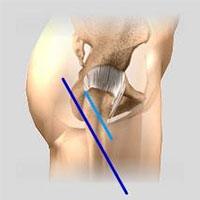 Minimally Invasive Hip Replacement Incisions