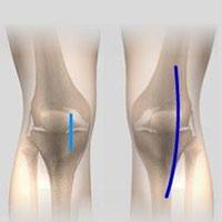 Minimally Invasive Knee Replacement Incisions