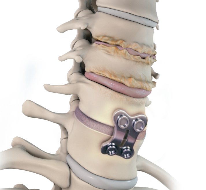 Adjacent Segment Disc Disease Images