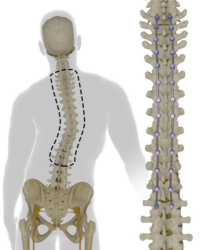 Scoliosis Treatment Images