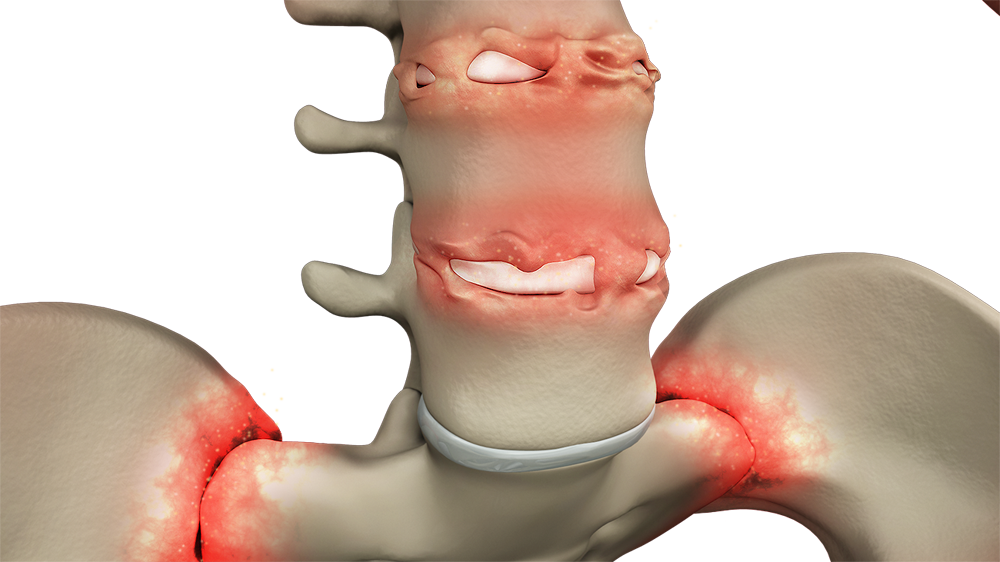 Ankylosing Spondylitis Images
